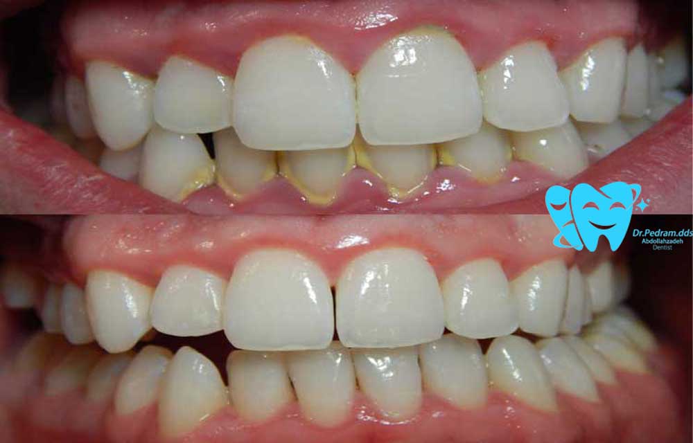 نمونه کار جرم‌گیری دندان