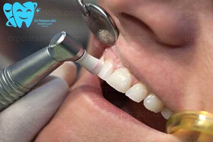 جرم‌گیری دندان توسط دستگاه التراسونیک
