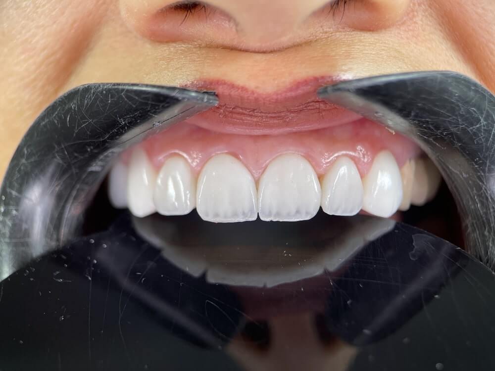 نمونه کار قبل و بعد لمینت دندان